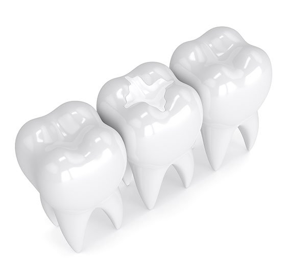 dental-fillings-breslau-dentist-dental-clinic