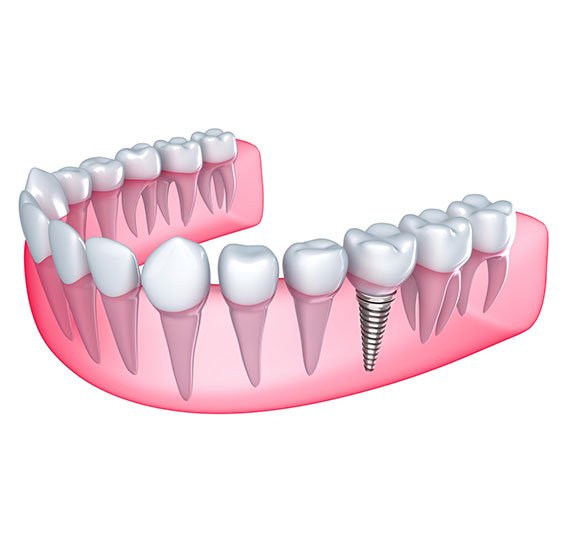 dental implants breslau dentist dental office