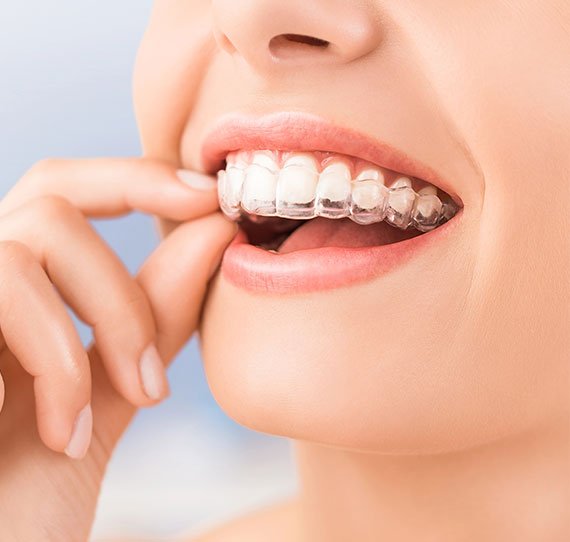 invisalign clear braces breslau dentist office dental