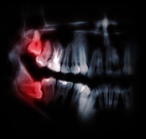 tooth extraction wisdom teeth breslau dentist