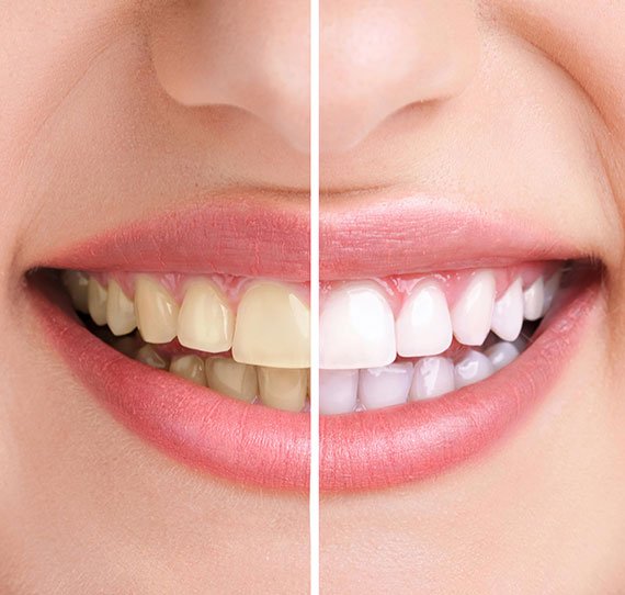 zoom teeth whitening breslau dentist dental office